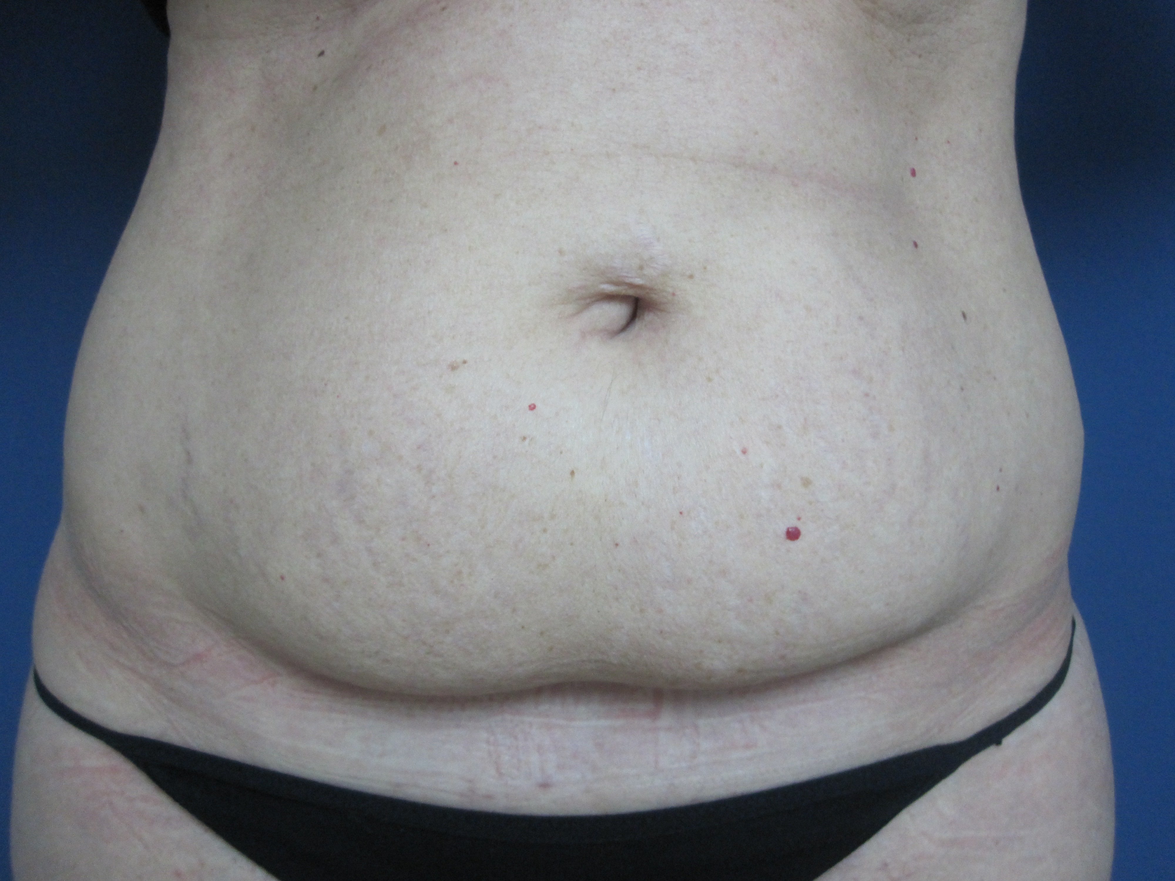 Dolor abdomen despues de cesarea